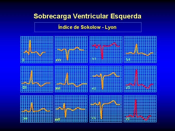 Sobrecarga Ventricular Esquerda Índice de Sokolow - Lyon DI a. Vr V 1 V