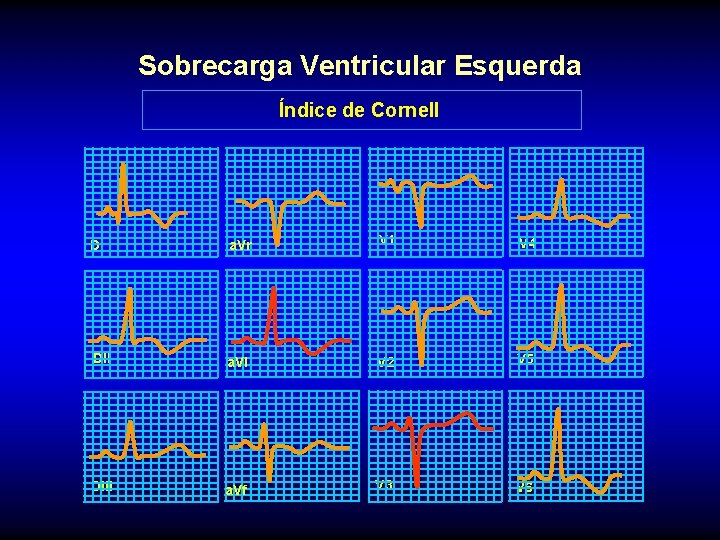 Sobrecarga Ventricular Esquerda Índice de Cornell DI a. Vr V 1 V 4 DII