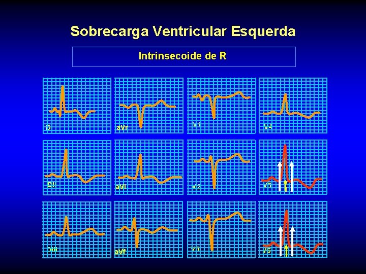 Sobrecarga Ventricular Esquerda Intrinsecoide de R DI a. Vr V 1 V 4 DII