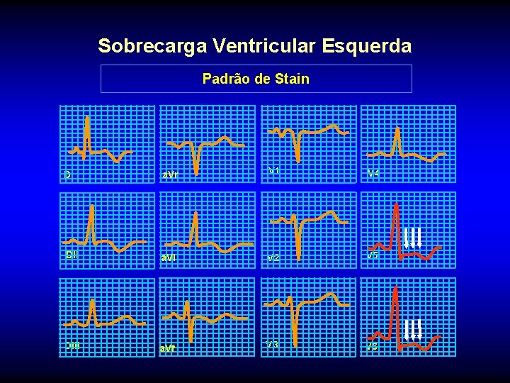 Sobrecarga Ventricular Esquerda Padrão de Stain DI a. Vr V 1 V 4 DII
