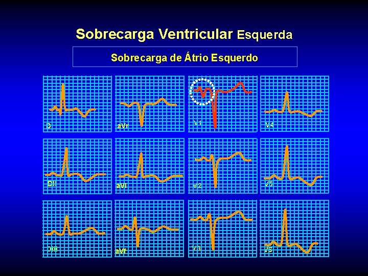 Sobrecarga Ventricular Esquerda Sobrecarga de Átrio Esquerdo DI a. Vr V 1 V 4