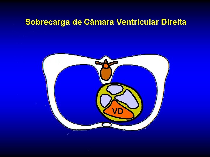 Sobrecarga de Câmara Ventricular Direita VD 