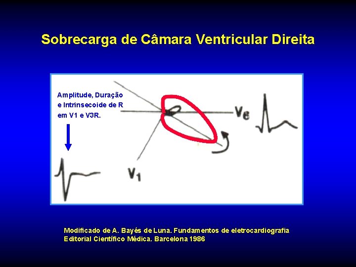 Sobrecarga de Câmara Ventricular Direita Amplitude, Duração e Intrinsecoide de R em V 1