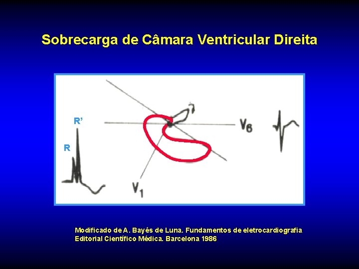 Sobrecarga de Câmara Ventricular Direita R’ R Modificado de A. Bayés de Luna. Fundamentos