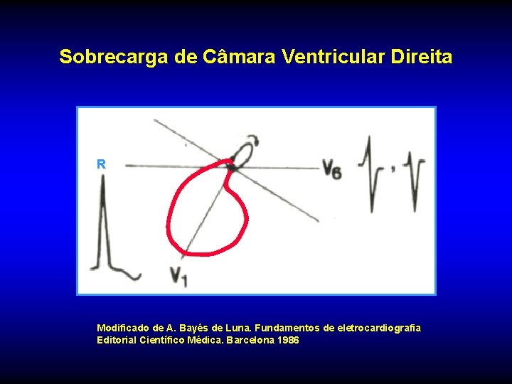 Sobrecarga de Câmara Ventricular Direita R Modificado de A. Bayés de Luna. Fundamentos de