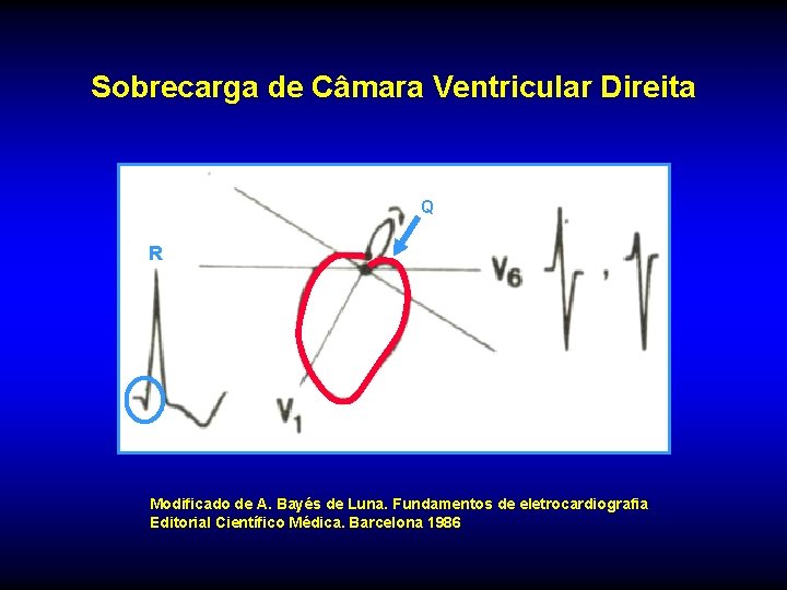 Sobrecarga de Câmara Ventricular Direita Q R Modificado de A. Bayés de Luna. Fundamentos