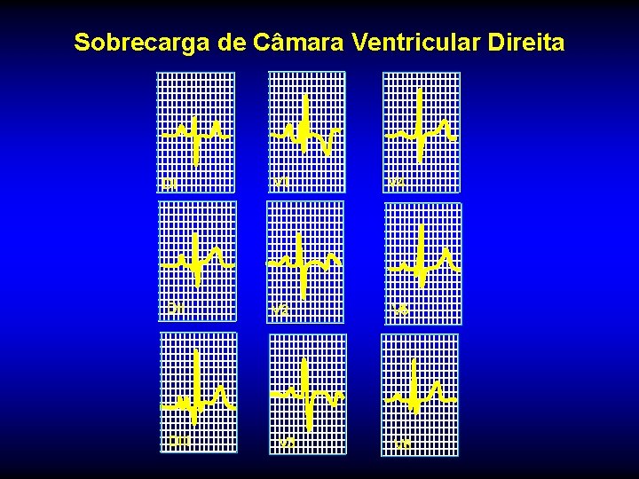 Sobrecarga de Câmara Ventricular Direita DI DIII V 1 V 4 V 2 V