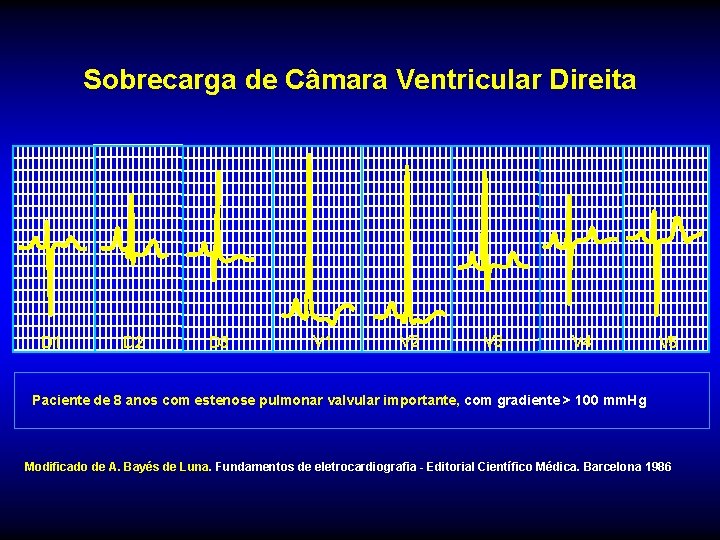 Sobrecarga de Câmara Ventricular Direita D 1 D 2 D 3 V 1 V