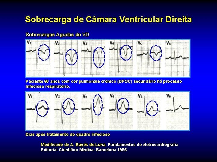 Sobrecarga de Câmara Ventricular Direita Sobrecargas Agudas do VD Paciente 60 anos com cor