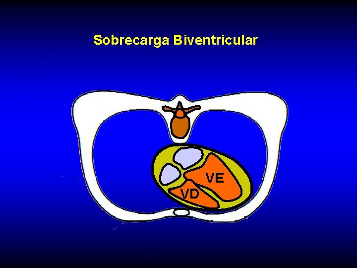 Sobrecarga Biventricular VE VD 