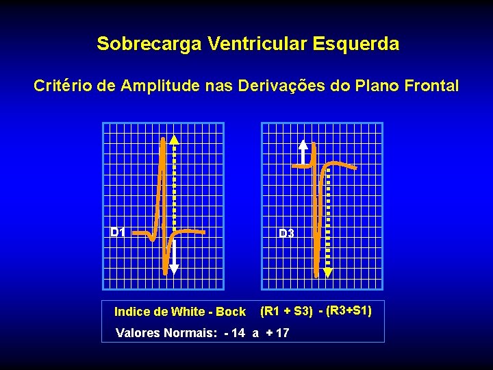 Sobrecarga Ventricular Esquerda Critério de Amplitude nas Derivações do Plano Frontal D 1 Indice