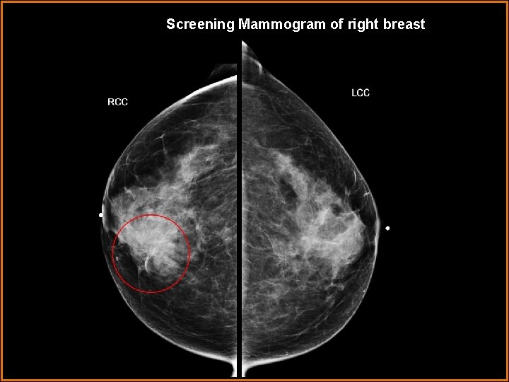 Screening Mammogram of right breast 