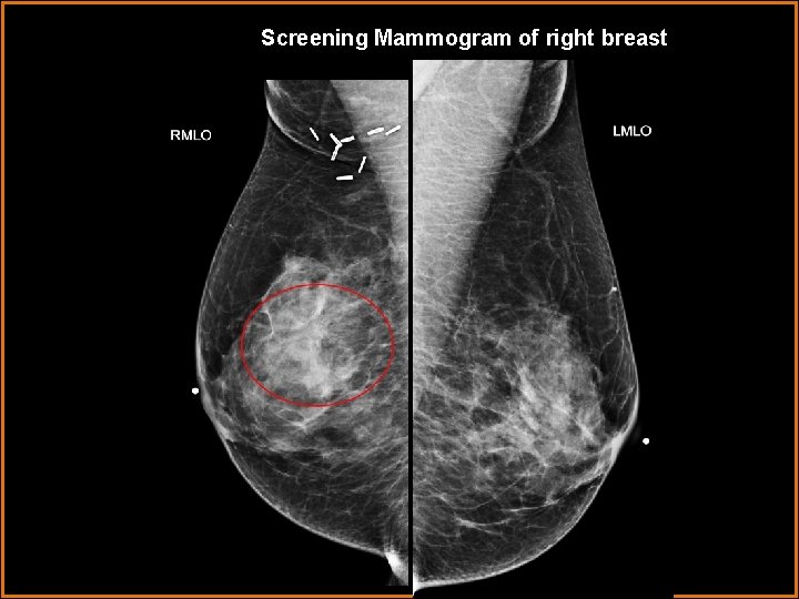 Screening Mammogram of right breast 