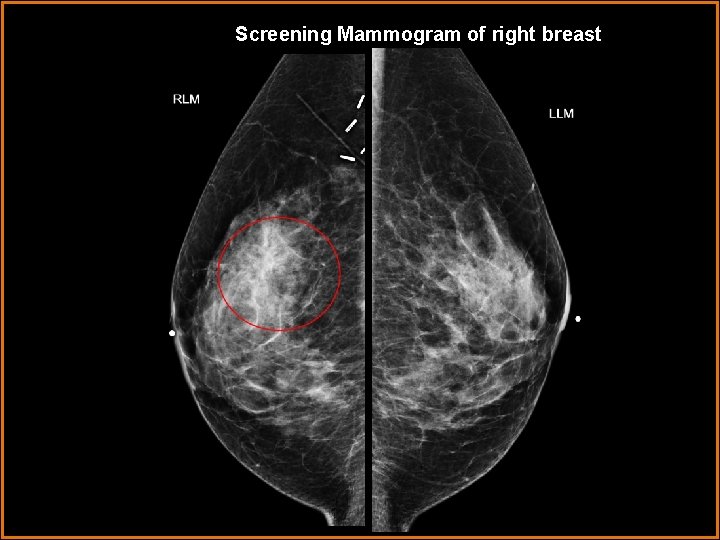 Screening Mammogram of right breast 