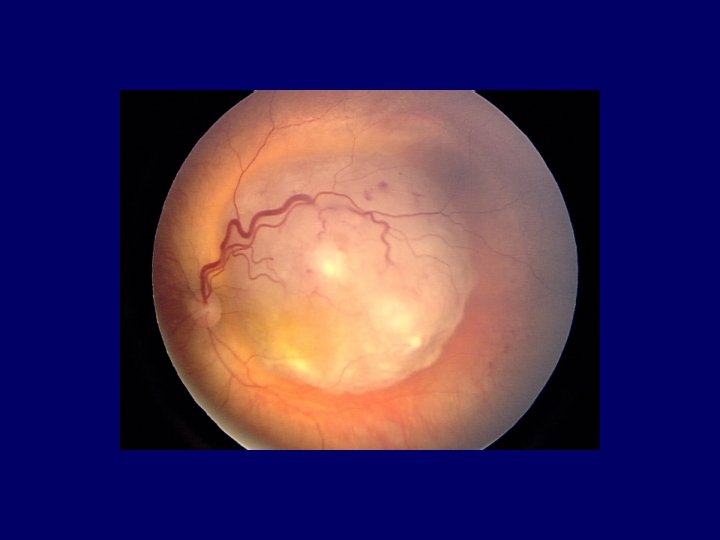 International Classification of Retinoblastoma Group A Small tumors