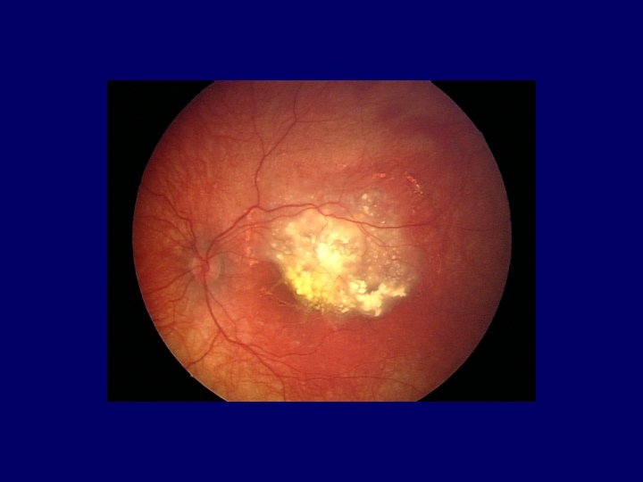 International Classification of Retinoblastoma Group A Small tumors