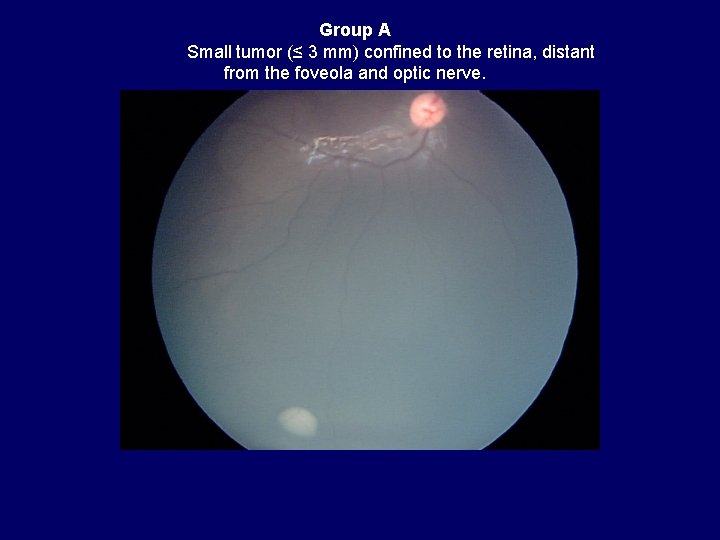 Group A Small tumor (≤ 3 mm) confined to the retina, distant from the