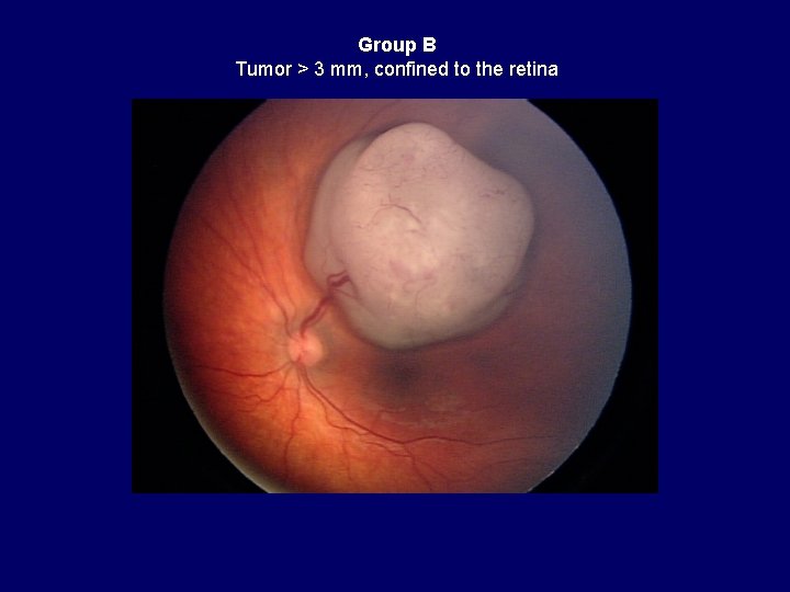 Group B Tumor > 3 mm, confined to the retina 