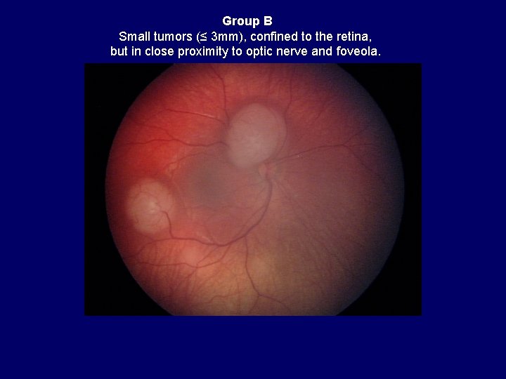 Group B Small tumors (≤ 3 mm), confined to the retina, but in close