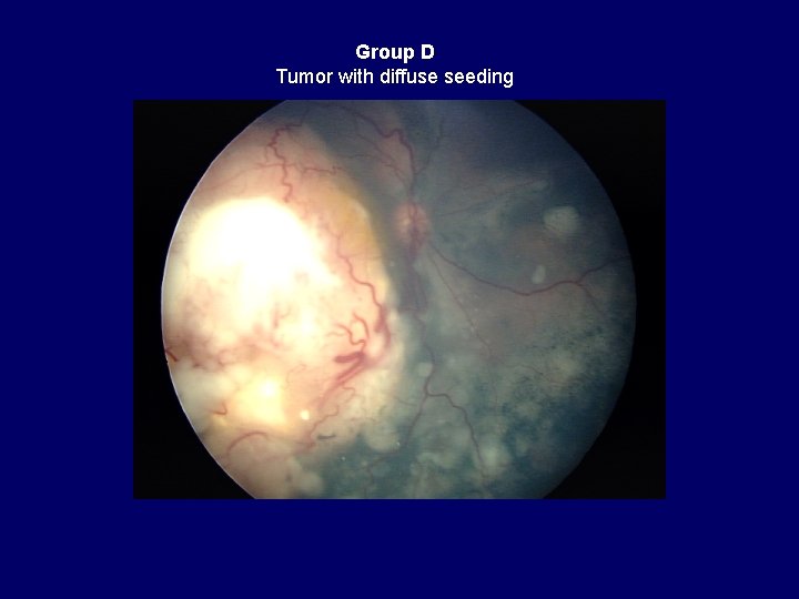 Group D Tumor with diffuse seeding 
