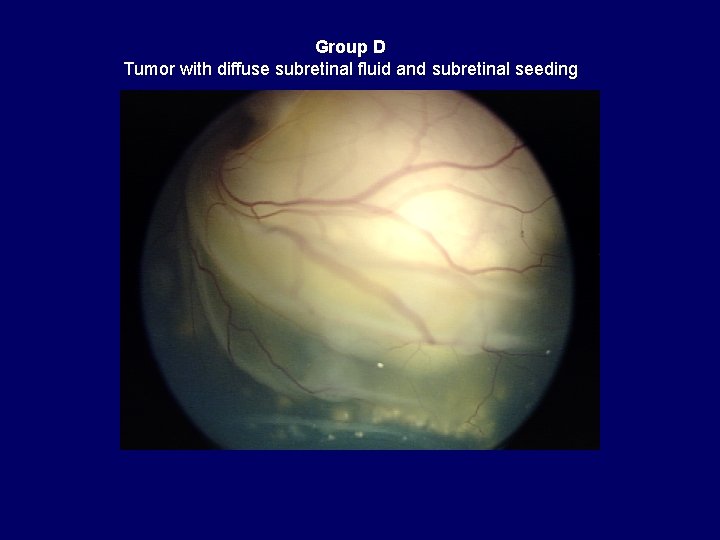 Group D Tumor with diffuse subretinal fluid and subretinal seeding 