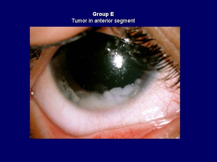 Group E Tumor in anterior segment 
