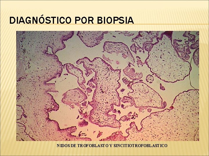 DIAGNÓSTICO POR BIOPSIA NIDOS DE TROFOBLASTO Y SINCITIOTROFOBLASTICO 