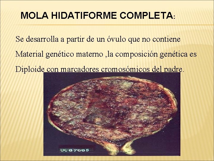 MOLA HIDATIFORME COMPLETA: Se desarrolla a partir de un óvulo que no contiene Material