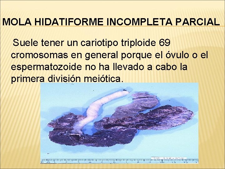 MOLA HIDATIFORME INCOMPLETA PARCIAL Suele tener un cariotipo triploide 69 cromosomas en general porque