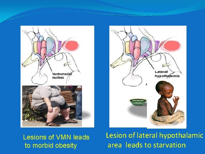 Lesions of VMN leads to morbid obesity Lesion of lateral hypothalamic area leads to