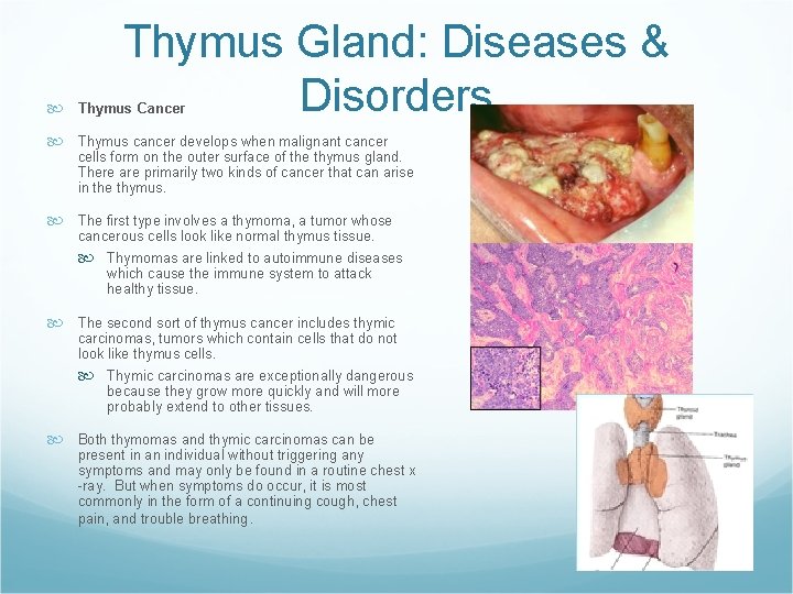 Thymus Gland: Diseases & Disorders Thymus Cancer Thymus cancer develops when malignant cancer cells