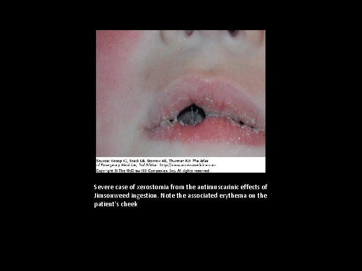 Severe case of xerostomia from the antimuscarinic effects of Jimsonweed ingestion. Note the associated