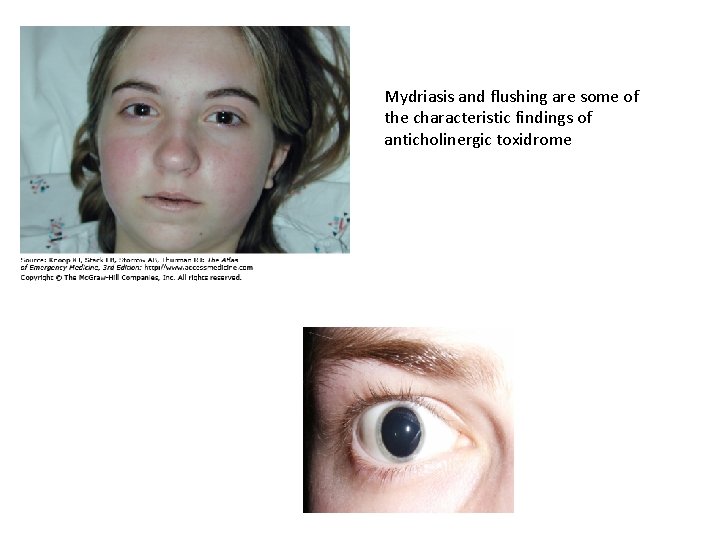 Mydriasis and flushing are some of the characteristic findings of anticholinergic toxidrome 