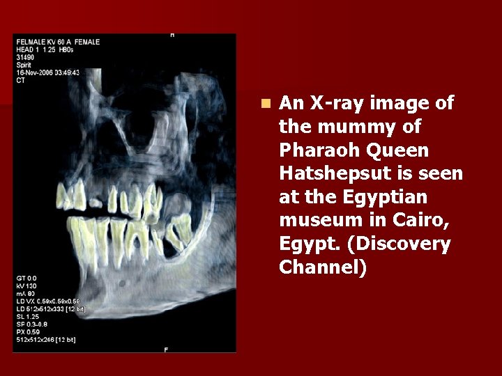 n An X-ray image of the mummy of Pharaoh Queen Hatshepsut is seen at