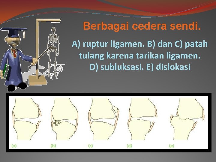 Berbagai cedera sendi. A) ruptur ligamen. B) dan C) patah tulang karena tarikan ligamen.