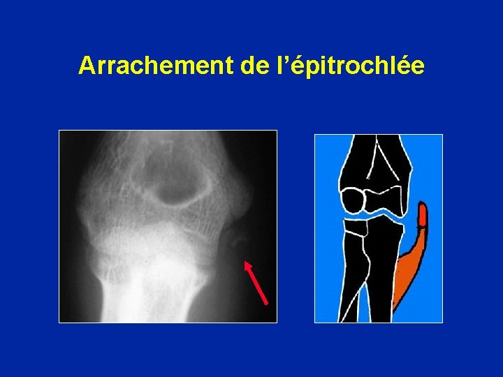 Arrachement de l’épitrochlée 