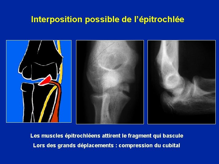 Interposition possible de l’épitrochlée Les muscles épitrochléens attirent le fragment qui bascule Lors des