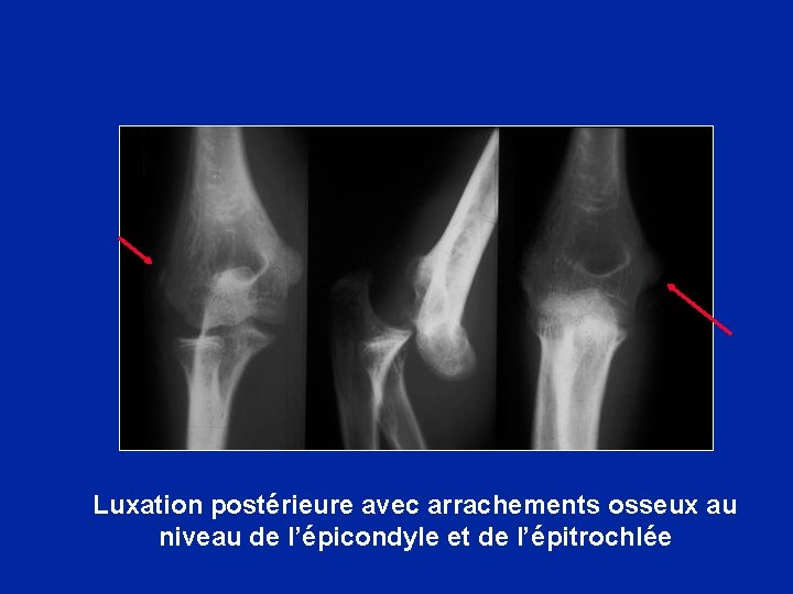 Luxation postérieure avec arrachements osseux au niveau de l’épicondyle et de l’épitrochlée 