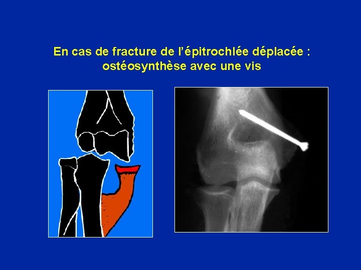 En cas de fracture de l’épitrochlée déplacée : ostéosynthèse avec une vis 