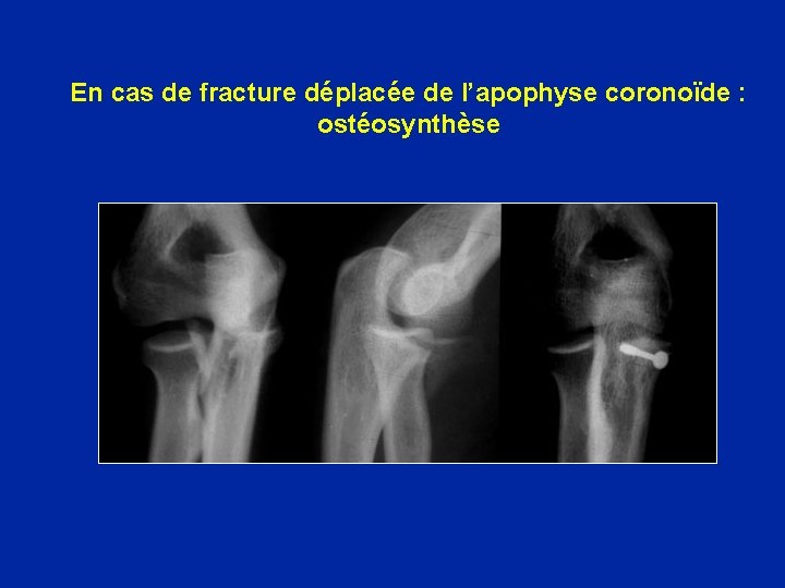  En cas de fracture déplacée de l’apophyse coronoïde : ostéosynthèse 