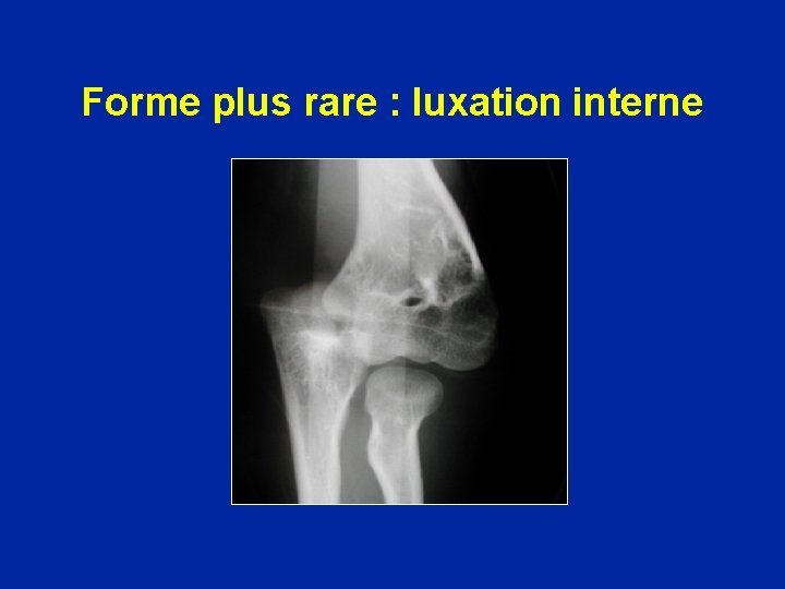 Forme plus rare : luxation interne 