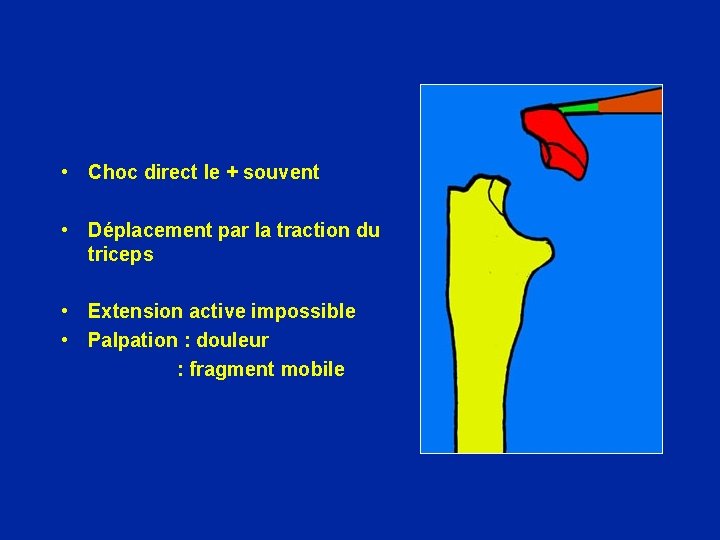  • Choc direct le + souvent • Déplacement par la traction du triceps