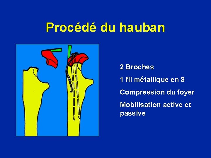 Procédé du hauban 2 Broches 1 fil métallique en 8 Compression du foyer Mobilisation