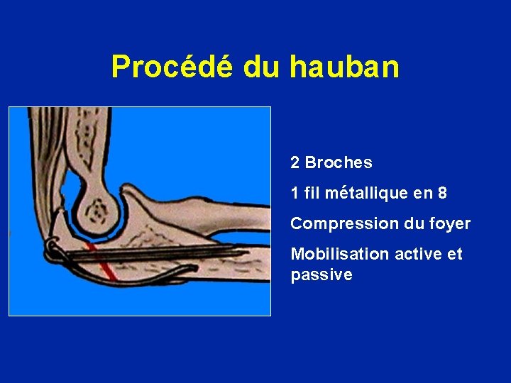 Procédé du hauban 2 Broches 1 fil métallique en 8 Compression du foyer Mobilisation