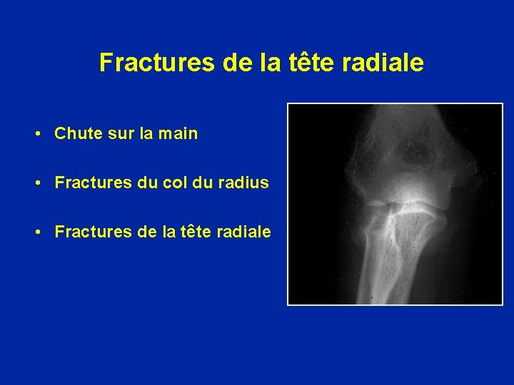 Fractures de la tête radiale • Chute sur la main • Fractures du col