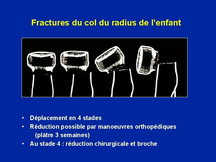 Fractures du col du radius de l’enfant • Déplacement en 4 stades • Réduction