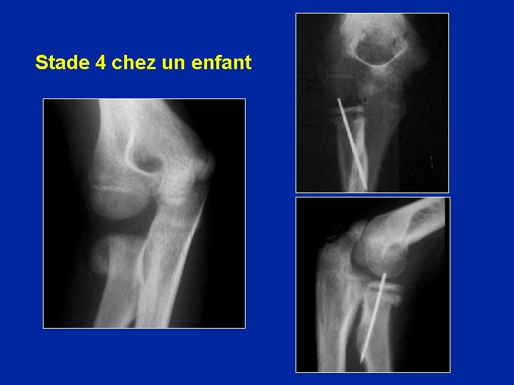 Stade 4 chez un enfant 