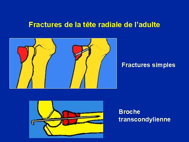 Fractures de la tête radiale de l’adulte Fractures simples Broche transcondylienne 