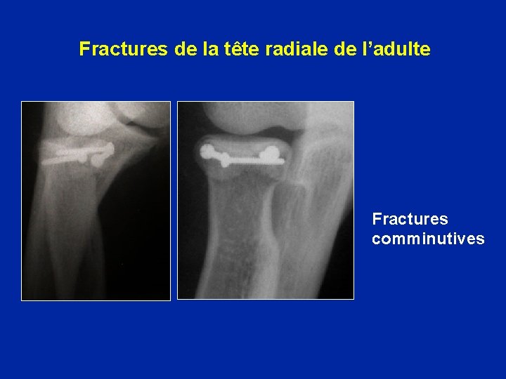 Fractures de la tête radiale de l’adulte Fractures comminutives 