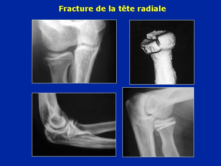 Fracture de la tête radiale 